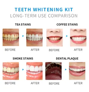 Groothandel Draadloze Whitening Apparaten Thuis Tanden Whitening Kits Led Licht Tanden Whitening Kit