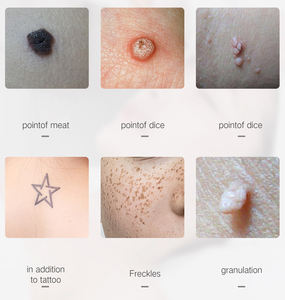 Stylo d'élimination des grains de beauté à 9 niveaux OEM ODM Dispositif d'élimination des taches de rousseur portable Outil d'élimination des taches de rousseur pour la personnalisation de la marque - Product Image 2