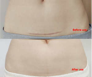 Gel Perawatan Bekas Luka Transparan Grosir Pabrik, Plester Luka Efektif untuk Menghilangkan Bekas Luka 20g/tube - Product Image 6