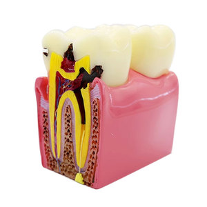 Estudio directo de fábrica <span class=keywords><strong>dentista</strong></span> anatómico oral cariado diente común enfermedades dentales modelo de comparación - Product Image 1