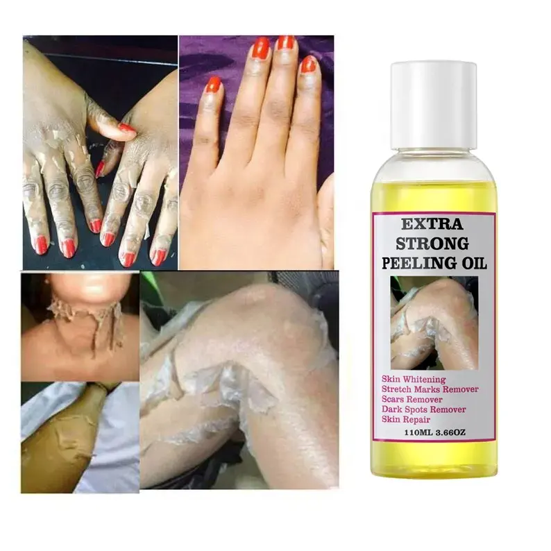 Óleo de peeling amarelo para clareamento da pele, removedor de estrias, removedor de manchas escuras, óleo forte de peeling verde amarelo