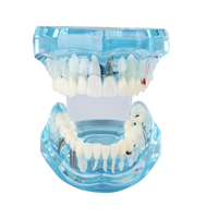 Modelo Dental de Puente de Restauración Dental con Dientes Removibles Estándar, Modelo de Resina para Implantes, Modelo de Tipodonto para Enfermedades Dentales, para Estudio de Ciencias Médicas y Odontología