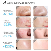 Kit facial pour éliminer les boutons et les points noirs, exfoliant doux, lotion éclaircissante pour le visage, acide salicylique, masque d'argile anti-acné