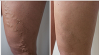 Machine de liposuccion de traitement endoveineux EVLT à diode laser 1470nm pour l'élimination des varices de la jambe faciale Soins personnels de beauté