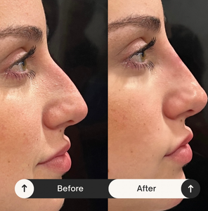 Z Rejeon Korea <strong>PDO</strong> PCL PLLA Thread Medical Grade for Facial Lifting - Product Image 4