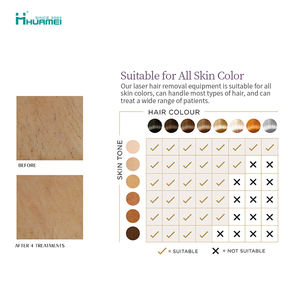 Depilación Láser de Diodo de Triple Longitud de Onda 755 808 1064, Depilación Láser de Diodo de 3 Longitudes de Onda - Product Image 6