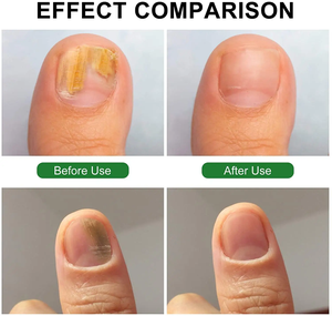 Appareil professionnel de traitement des mycoses des ongles pour l'onychomycose et l'élimination des champignons des ongles - Product Image 4