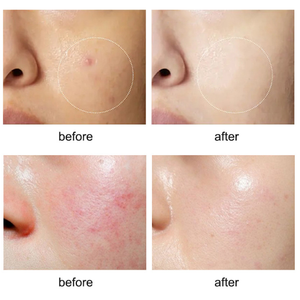 Nhãn hiệu riêng chống lão hóa da làm trắng giữ ẩm dưỡng ẩm salicylic axit chống mụn trứng cá điều trị Mặt huyết thanh - Product Image 6