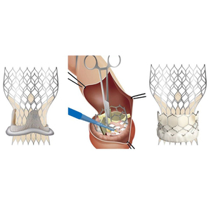 Tubos Médicos de Nitinol de Pared Delgada para Aplicaciones de Stents Coronarios - Product Image 5