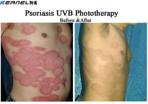Lampu Vitiligo Uvb KN-4004B1, lampu fototerapi mesin fototerapi untuk <span class=keywords><strong>Psoriasis</strong></span> dan Vitiligo - Product Image 6