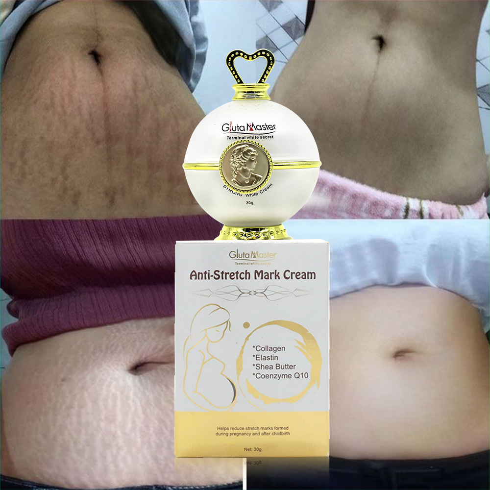 High Quality Stretch Marks Remover Skin Repair Cream Treatment Scar Removal Pregnancy Cream Stretch Mark Cream for the Body