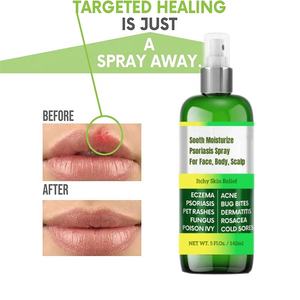 Eczema-tratamiento <span class=keywords><strong>para</strong></span> la Psoriasis, antipicazón espray hidratante <span class=keywords><strong>para</strong></span> el acné, <span class=keywords><strong>Dermatitis</strong></span>, sacea, alivio del cuero cabelludo <span class=keywords><strong>para</strong></span> niños y adultos - Product Image 3