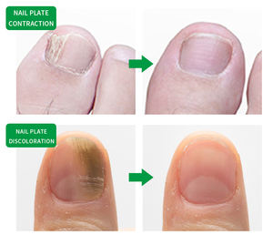 BSHIPRO Líquido Antifúngico Herbal Tolunaftato 4ML para el Cuidado <span class=keywords><strong>de</strong></span> la Piel y <span class=keywords><strong>Uñas</strong></span> <span class=keywords><strong>de</strong></span> <span class=keywords><strong>los</strong></span> Pies, Pie <span class=keywords><strong>de</strong></span> Atleta (Tinea Pedis) - Product Image 3