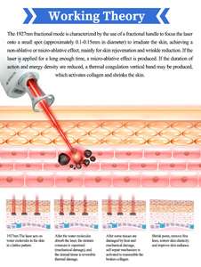Fourniture d'usine 1927nm Laser longueur d'onde haute puissance 600W supprimer les taches réduire les rides traitement des cicatrices d'acné meubles de salon - Product Image 3