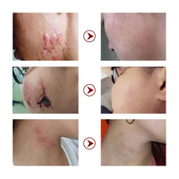 CARVENCHY Crème Avancée de Réparation et d'Élimination des Cicatrices Gel de Silicone pour le Corps Vitamine C Huile d'Émeu Efficace Cicatrices Chirurgicales Brûlures Acné Vergetures