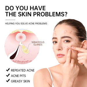 Meilleure crème <span class=keywords><strong>pour</strong></span> <span class=keywords><strong>les</strong></span> <span class=keywords><strong>boutons</strong></span> et <span class=keywords><strong>les</strong></span> taches sombres qui <span class=keywords><strong>les</strong></span> élimine et <span class=keywords><strong>les</strong></span> fait sécher, <span class=keywords><strong>pour</strong></span> <span class=keywords><strong>les</strong></span> femmes, crème séchante <span class=keywords><strong>pour</strong></span> <span class=keywords><strong>les</strong></span> <span class=keywords><strong>boutons</strong></span> - Product Image 6