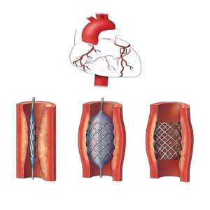 Tubi in Nitinol Superelastico per <span class=keywords><strong>Stent</strong></span> Vascolari e Dispositivi Endovascolari - Product Image 3