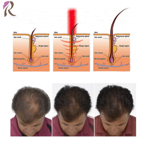 Equipo Multifuncional para el Cuidado del Cuero Cabelludo para Centros Profesionales de Tratamiento de la Caída del Cabello, Tratamiento de la <span class=keywords><strong>Dermatitis</strong></span> Seborreica del Cuero Cabelludo - Product Image 5