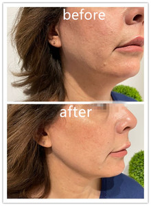 เครื่องเลเซอร์สลายไขมันแบบอัจฉริยะ Smart Touch Screen Endoskin Laserlift 1470nm+980nm Vaser Lipolysis พร้อมหัวแคนูลา Endolaser Lift - Product Image 6