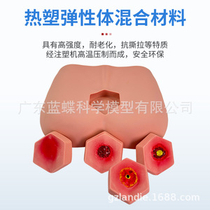 Modelo de cuidado de úlceras por presión por etapas, enseñanza de cuidado de ancianos, capacitación en el cuidado de úlceras por presión por etapas, cuidado de úlceras por presión - Product Image 4