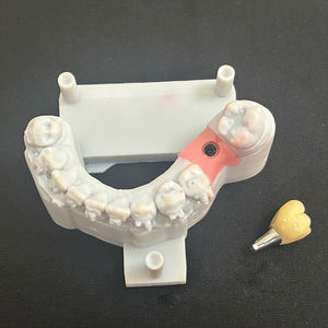 Prothèse dentaire implantable hybride avec fournitures en porcelaine pour les gencives, abutments personnalisés en zircone et titane pour les implants, tout sur 4 - Product Image 4