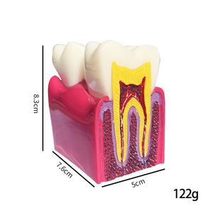 Kits éducatifs pour l'enseignement dentaire : Modèle de comparaison des caries 4x, Modèle de cavité buccale, Modèle de dent - Product Image 3