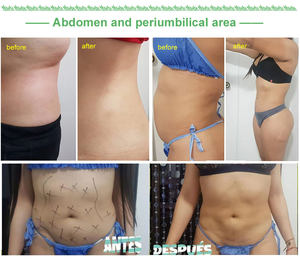 Macchina per Liposuzione Vaser, Dimagrimento Corporeo, <span class=keywords><strong>Laser</strong></span> a Diodi 9801470nm, Lipolisi, Rassodamento della Pelle, Lifting <span class=keywords><strong>Laser</strong></span> Endo - Product Image 6