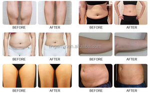 Macchina Professionale per Criolipolisi a 360° con Doppio Manipolo, Rimozione del Grasso con Lipo Laser - Product Image 4