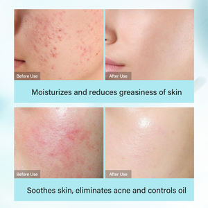 התווית פרטית skincare סט עבור מוצרי טיפוח העור, כולל חומצה סליצילית bha שמן אקנה קרם יותר - Product Image 5