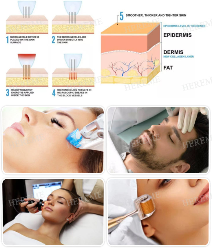 Hot Anti-wrinkle Meso Liquid Solution Hyaluronic acid VB12 VC HA Mesotherapy injection