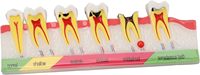 Modelo de desarrollo de caries dental de anatomía, modelos de dientes dentales para estudio de anatomía dental, educación de cuidado bucal y médico-paciente