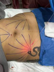 आईबैग हटाने फेस लिफ्ट एंडोलेज़र 980nm 1470nm वसा विलयन इंजेक्शन शरीर लिपोसक्शन/लिपोसक्शन 400 फाइबर वजन घटाने डिवाइस - Product Image 3