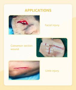 Dispositif de Fermeture de Plaies à Fermeture Éclair Sans Douleur pour Urgences, Vente en Gros Usine, Pansement à Fermeture Éclair Désinfectant pour Fermetures de Plaies - Product Image 5