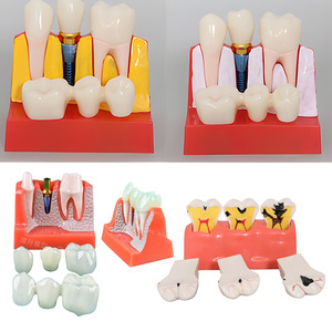 Modèle d'enseignement dentaire anatomique en résine pour implant dentaire, préparation au brossage des prothèses - Product Image 5