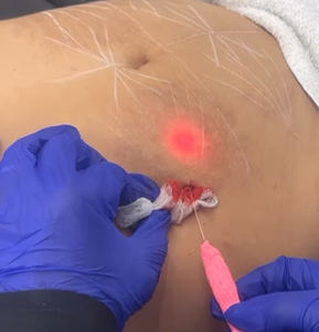 جهاز إذابة الدهون 980 نانومتر و1470 نانومتر لإزالة الدهون العنيدة/جهاز ليزر ديود لشفط الدهون ورفع الوجه - Product Image 6