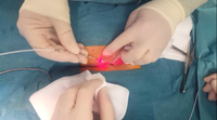 Arfurla Nouveauté Laser Diode 1470nm pour Hémorroïdes Internes et Externes, Fistules, Double Longueur d'Onde 980nm, Inde DDP