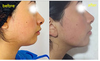 Laser Offre Spéciale 1470nm pour la peau de levage faciale serrant le dispositif approuvé de CE de liposuccion de laser