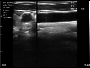 Sonda Inalámbrica de 80 Elementos DMU39, Sonda Endocavitaria, Ultrasonido Doppler Color para Examen Ginecológico Transvaginal - Product Image 5