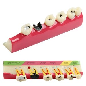Dental <b>Teeth</b> Model 6-Stage Caries Development Educational Model for Periodontal Disease Patient Display - Product Image 2