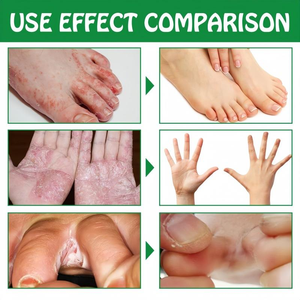 Vente en gros de crème et de spray pour les pieds anti-démangeaisons: soulager rapidement la douleur et utiliser des ingrédients naturels pour traiter les infections fongiques - Product Image 4