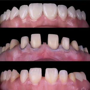 Dentiera denti finti fissi Zirconia denti corone & ponti laboratorio dentale cinese con la migliore qualità - Product Image 4