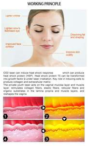 เครื่องเลเซอร์ CO2 แบบ Fractional รุ่นใหม่ล่าสุด สำหรับการฟื้นฟูผิวอย่างมืออาชีพ กำจัดเม็ดสี ลบรอยสัก กระชับผิว - Product Image 3