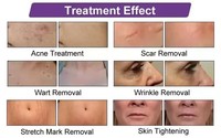 Appareil de beauté professionnel ABS pour le visage et le corps, anti-rides, anti-acné, traitement des cernes, raffermissant pour les lèvres CN/UK/EU/JP