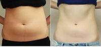 Triangel Top Sale Diode Laser 980nm 1470nm Appareil de lipolyse par laser, liposuccion, endolaser, raffermissement de la peau, lifting du visage et du cou