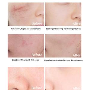 Suero Facial 100% con Extracto de Centella Asiática para Piel Sensible y Propensa al Acné, Suero Facial Coreano - Product Image 5