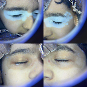 Lampu Kayu Portabel Kernel, Lampu UV Medis untuk Analisis Kulit Wajah, Penganalisis Kulit, Penyakit Kulit, Vitiligo, Psoriasis - Product Image 3