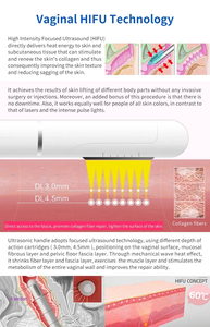 Appareil de raffermissement vaginal HIFU à ultrasons focalisés de haute intensité pour le soin et la revitalisation vaginale - Product Image 4