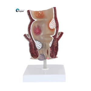 Medizinisches Lehr modell Rektales Pathologie modell für die Ausbildung von Prokto logie und Anatomie - Product Image 1
