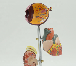 Model Anatomi Kaki Diabetik Ilmu Kedokteran Menunjukkan Pola <span class=keywords><strong>Diabetes</strong></span> Termasuk Pola Organ Patologis - Product Image 5
