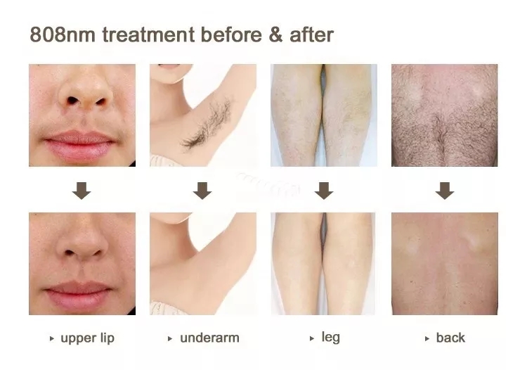 Stand 2 in 808nm diode hair removal and nd yag laser tattoo removal machine